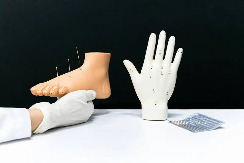 Akupunktur bei Polyneuropathie