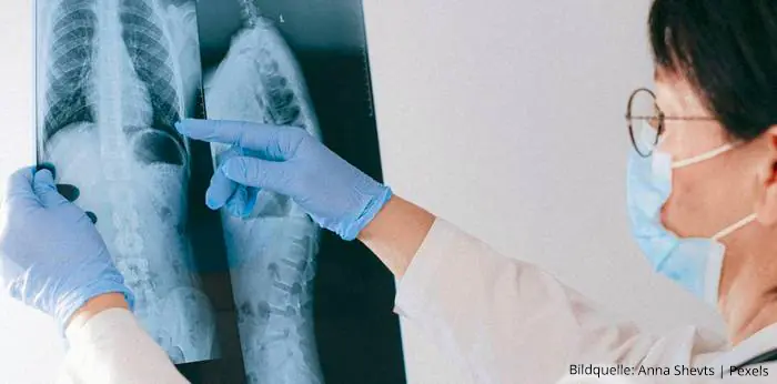 Vibrationstherapie mit Marodyne LiV kann bei Idiopathischer Skoliose helfen