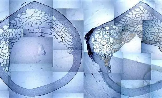 Osteoporose Knochenschaubild Querschnitt