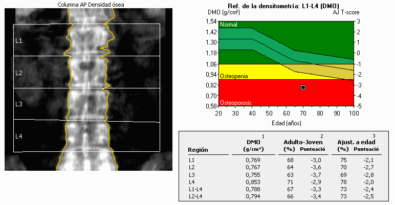 DXA Knochendichtmessung Grafik